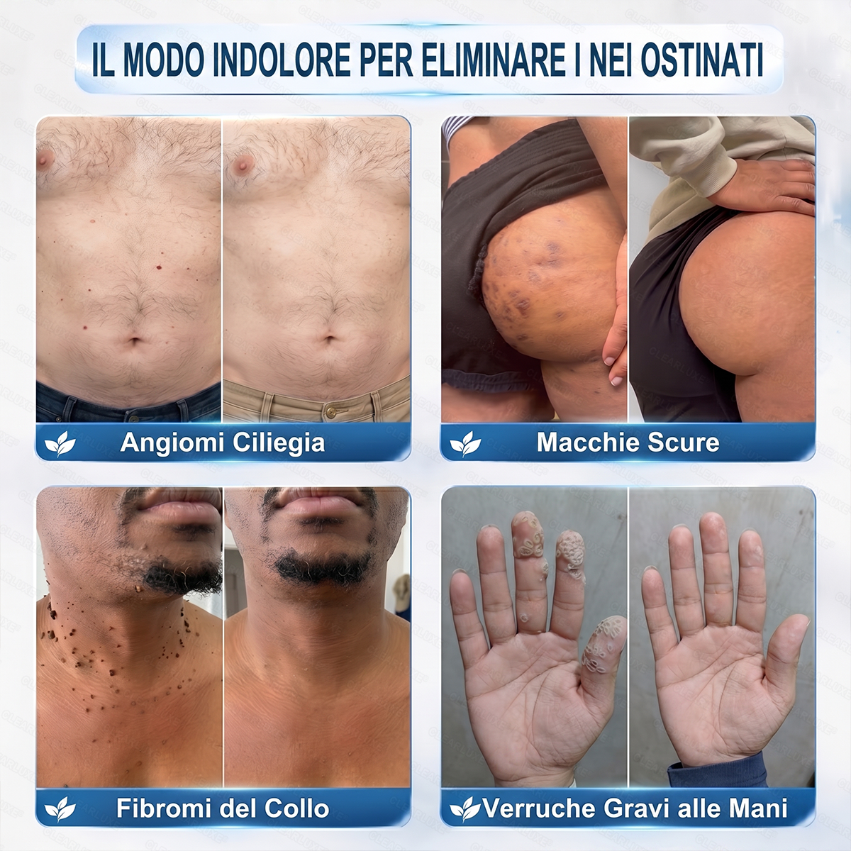 🔥 Rimaste solo 10 confezioni! Ottieni un ulteriore sconto del 30%.✅𝑯𝗲𝙖𝐥𝒓𝗶𝙯𝗲® 𝐂𝐚𝐧𝐜𝐞𝐥𝐥𝐚 𝐕𝐞𝐫𝐫𝐮𝐜𝐡𝐞 & 𝐈𝐦𝐩𝐞𝐫𝐟𝐞𝐳𝐢𝐨𝐧𝐢 𝐢𝐧 𝟕 𝐆𝐢𝐨𝐫𝐧𝐢🪄(𝙍𝙤𝙡𝙡𝙚𝙧𝙗𝙖𝙡𝙡 𝙎𝙚𝙣𝙯𝙖 𝘿𝙤𝙡𝙤𝙧𝙚, 𝙎𝙚𝙣𝙯𝙖 𝘾𝙞𝙘𝙖𝙩𝙧𝙞𝙘𝙞)👩‍⚕️