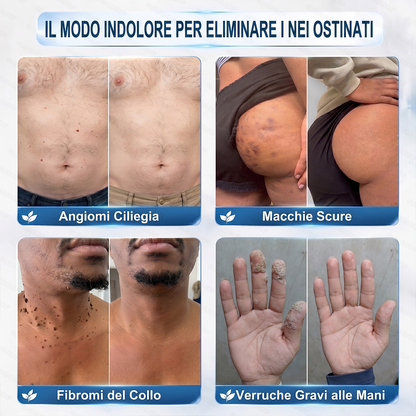 🔥 Rimaste solo 10 confezioni! Ottieni un ulteriore sconto del 30%.✅𝑯𝗲𝙖𝐥𝒓𝗶𝙯𝗲® 𝐂𝐚𝐧𝐜𝐞𝐥𝐥𝐚 𝐕𝐞𝐫𝐫𝐮𝐜𝐡𝐞 & 𝐈𝐦𝐩𝐞𝐫𝐟𝐞𝐳𝐢𝐨𝐧𝐢 𝐢𝐧 𝟕 𝐆𝐢𝐨𝐫𝐧𝐢🪄(𝙍𝙤𝙡𝙡𝙚𝙧𝙗𝙖𝙡𝙡 𝙎𝙚𝙣𝙯𝙖 𝘿𝙤𝙡𝙤𝙧𝙚, 𝙎𝙚𝙣𝙯𝙖 𝘾𝙞𝙘𝙖𝙩𝙧𝙞𝙘𝙞)👩‍⚕️